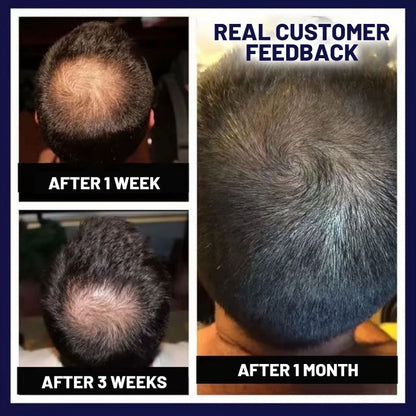 🌿AKTION ZUM LETZTEN TAG – 50 % RABATT🌿 HZA™ Natürliches Haarwuchsspray